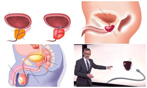 healthy and diseased prostate